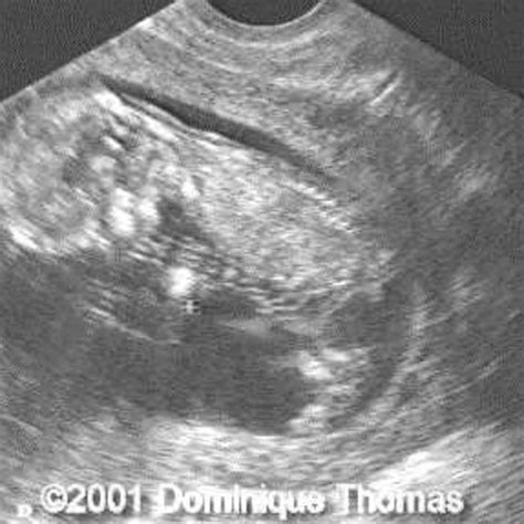 Ambiguous Genitalia Ultrasound