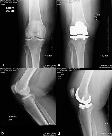 The Cyclops Lesion After Bicruciate Retaining Total Knee Replacement