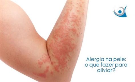 Alergia Na Pele O Que Fazer Para Aliviar Alergocl Nica