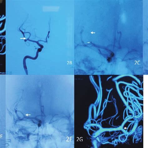 Digital Subtraction Angiography DSA Of A Ruptured Posterior