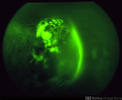 Choroidal Melanoma 1 Fluorescein Angiogram Retina Image Bank