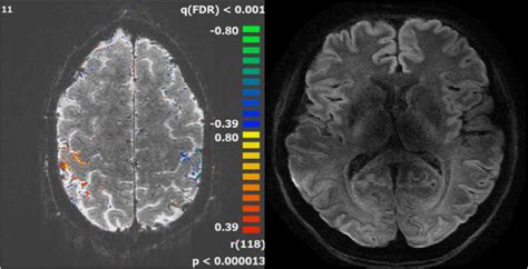 17 Example Of A Fmri Finger Tapping Activation Pattern Overlaid Onto