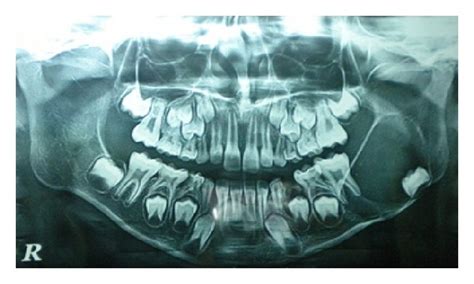 Opg Showing Well Defined Unilocular Radiolucency On The Left Side Of