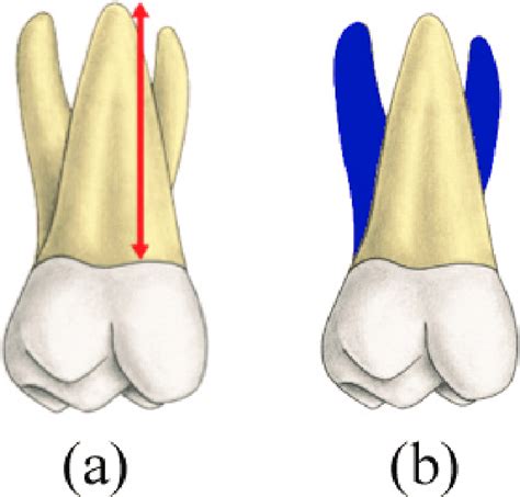 Palatal Aspect Of Maxillary First Molar Roots Reprinted From 3d Tooth