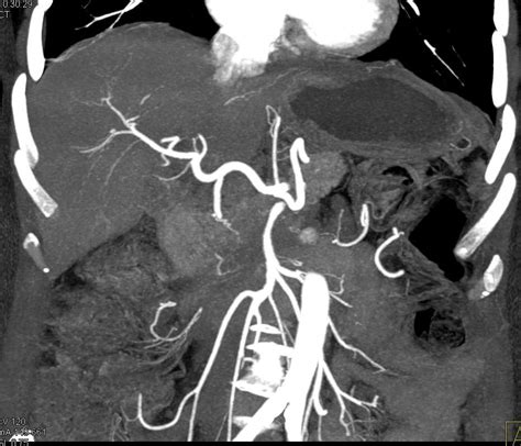 Pancreatic Adenocarcinoma With Vascular Encasement On Arterial And