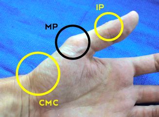 Joints of the Thumb – Language of Hand and Arm Surgery Series