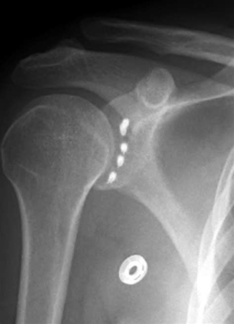 physiotherapy blogging: Shoulder: Bankart surgery rehabilitation