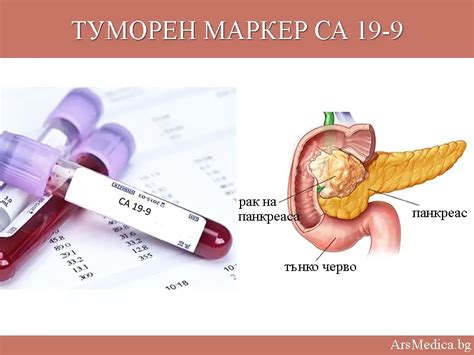 Шийна остеохондроза (цервикална остеохондроза) | ArsMedica.bg