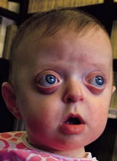 Pfeiffer Syndrome Pictures Types Symptoms Causes Treatment