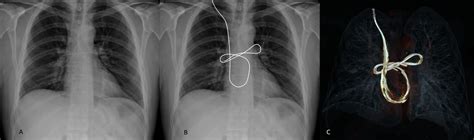 Intracardial Migration Of A Ventriculoperitoneal Shunt Bmj Case Reports