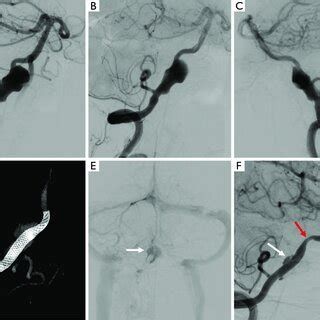 A Typical Case In The Flow Diversion Group A Pretreatment DSA