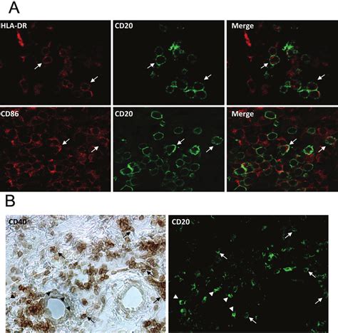 Synovium Infiltrated CD20 B Cells From Patients With RA Express HLA DR