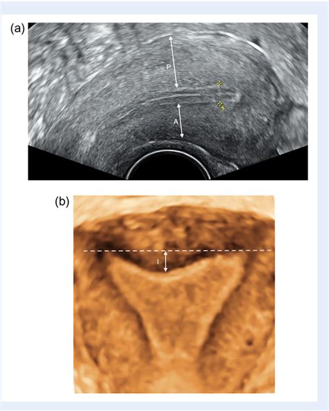 Figure From Eshre Esge Female Genital Tract Anomalies Classification