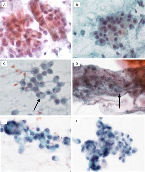 Cytomorphology Of Signet Ring Cells Srcs In Invasive Ductal Carcinoma