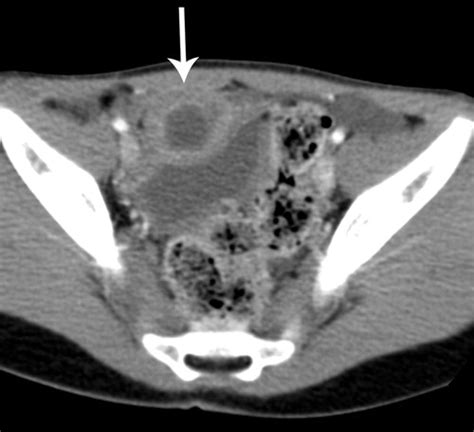 Inflammatory And Nonneoplastic Bladder Masses Radiologic Pathologic Correlation Radiographics