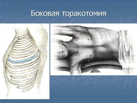 Кожный разрез при передней торакотомии начинается от - фото презентация