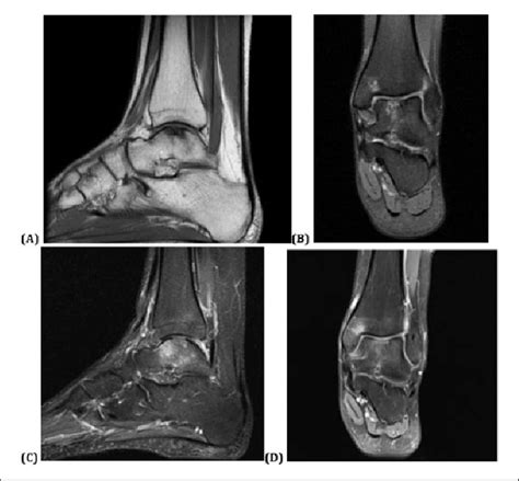 Preoperative Magnetic Resonance Imaging Mri A T1 Weighted Sagittal Download Scientific