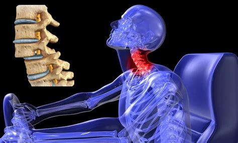 Fracturas De Columna Vertebral Por Osteoporosis The Best Porn Website