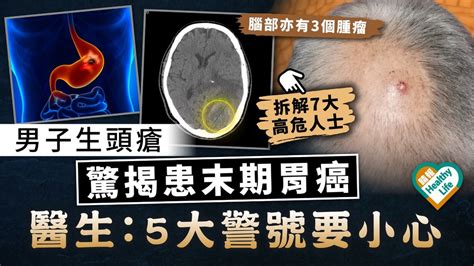 致命癌症｜男子生頭瘡 驚揭患末期胃癌 醫生：5大警號要小心 晴報 健康 腫瘤及癌症 D230415