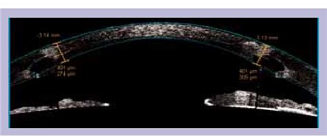 Anterior Segment Optical Coherence Tomography Showing The Precise