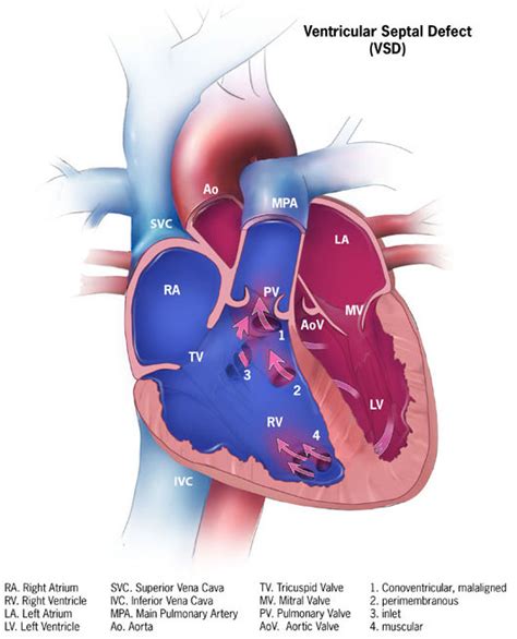 Ventricular Septal Defect Wikipedia