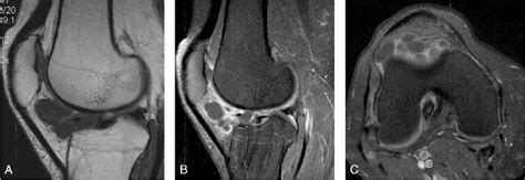 Magnetic Resonance Imaging Comparison Of Intra Articular Cavernous