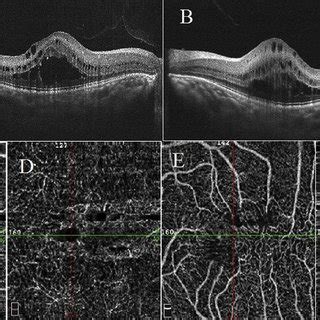 Multimodal Imaging Of The Second Case A And B Show Optical Coherence