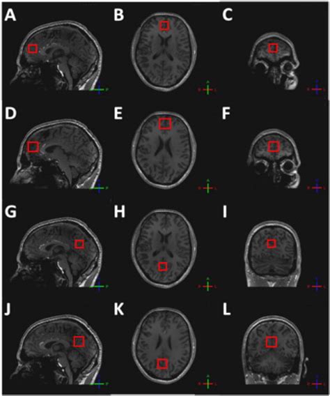 Voxel Placement A Medial Prefrontal SLASER Voxel A Sagittal View