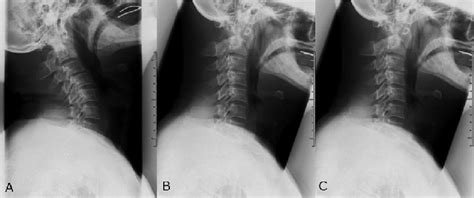 An X Ray Demonstrating Atlantoaxial Subluxation Aas And Assimilation