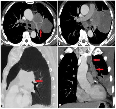 Diagnostics Free Full Text Ct Imaging Findings Of Pulmonary Artery Stenosis A Pictorial Review