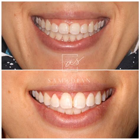 Laser Gum Contouring Before And After Photos Samadian Cosmetic