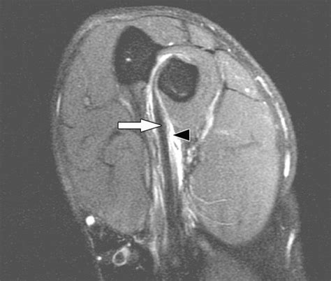 Distal Bicep Tendon Mri