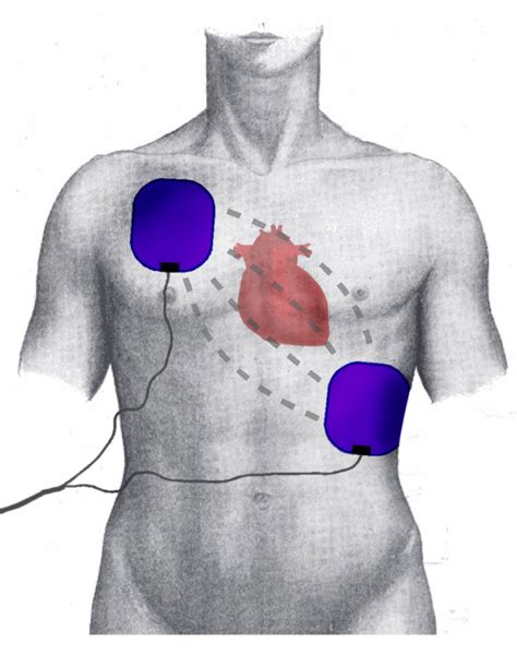 Figure Position Of Electrodes During Defibrillation Cardioversion