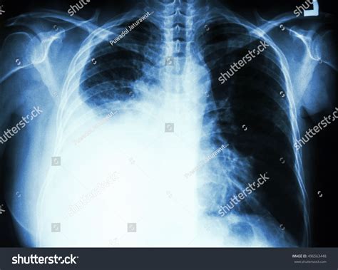 Chest X Ray Lung Cancer