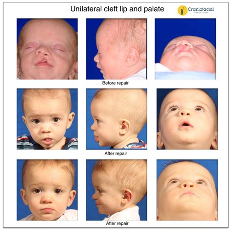 Cleft Lip And Palate Gallery Dell Childrens Craniofacial Team Of Texas