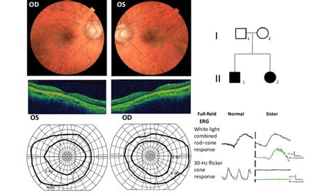 Up Left Ocular Fundus Of The Girl At Age 28 With Peripapillary