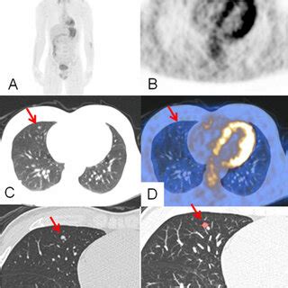 18F FDG PET CT Images For Staging Of A 30 Year Old Male Patient After