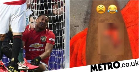 Anthony Martial Reveals Nasty Injury After Man Utd Beat Man City