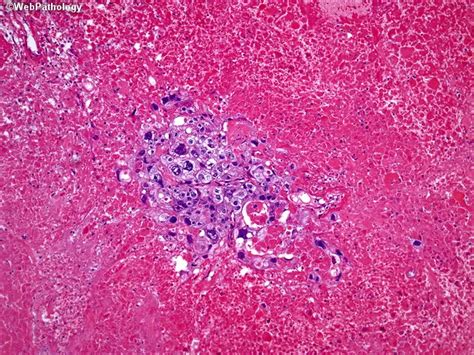 Choriocarcinoma Of Stomach