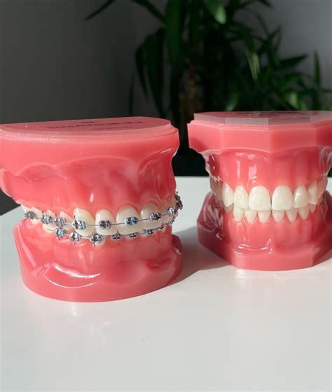 Types Of Braces Lingual Braces In Dublin Specialist Orthodontic