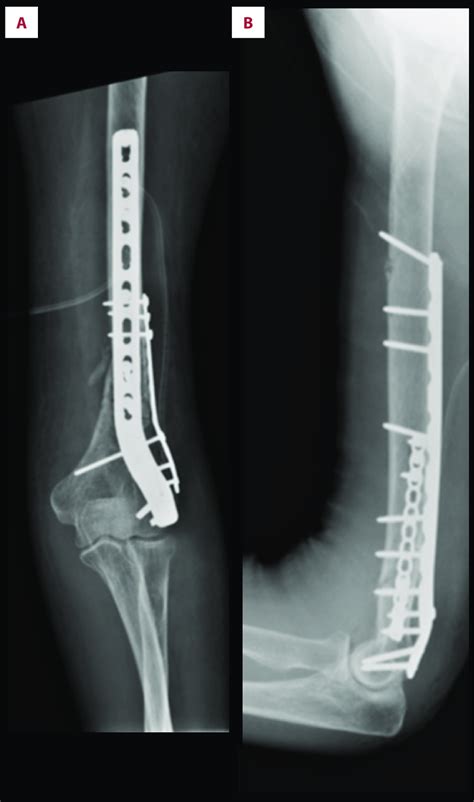 Postoperative Radiographs Showing Anterior Posterior A And Lateral