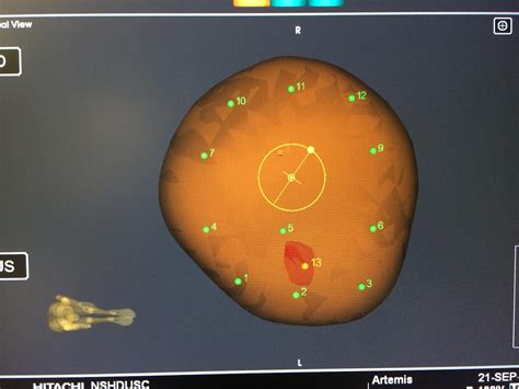 Prostate Mri Fusion Biopsy Procedure