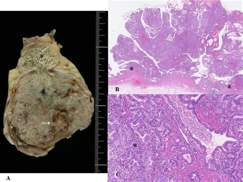 Intracholecystic Papillary Neoplasm Of Gallbladder A Gross Features