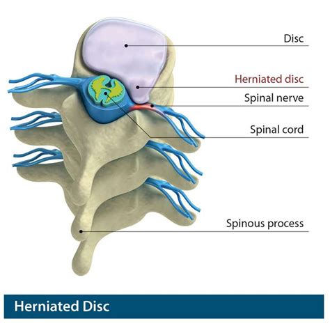 Herniated Disc Treatment Reno And Carson City Swift Institute