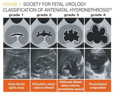 Fetal Hydronephrosis Ultrasound