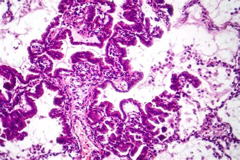 Lung Adenocarcinoma Stock Image Image Of Tumour Microscopy 130900741