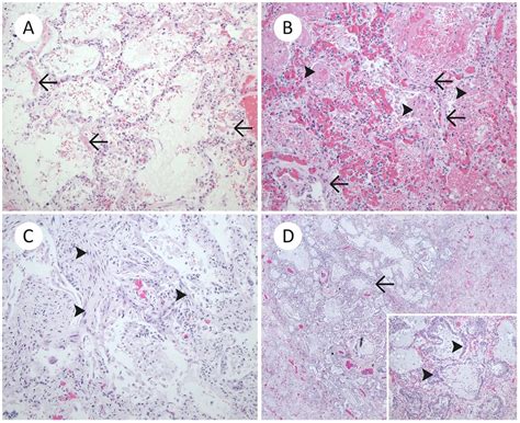 Fatal Pulmonary Fibrosis A Post Covid 19 Autopsy Case Journal Of