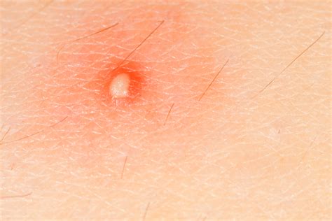 Staph Infection Symptoms, Treatments & Causes (Staphylococcus) | Page 7 ...