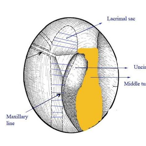 (PDF) Maxillary sinus antrostomy Pitfalls