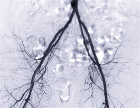 Femoral artery, CT scan - Stock Image - F037/7159 - Science Photo Library